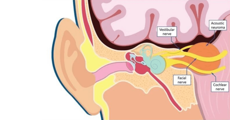 Most ringing in the ear is a frustrating but straightforward case of tinnitus. Sometimes, however, the tone you’re hearing may be symptomatic of other issues, including the presence of a noncancerous tumor on the auditory nerve, called an acoustic neuroma. 