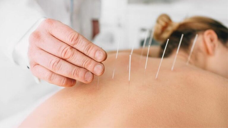 woman getting acupuncture for tinnitus relief