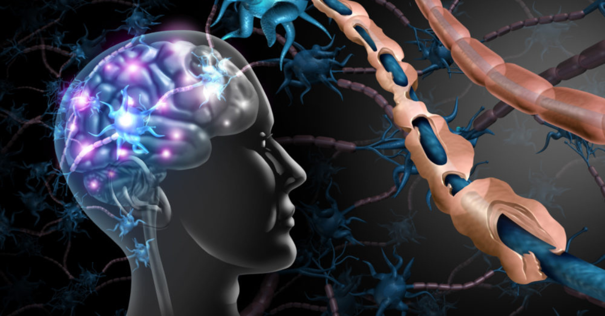 multiple sclerosis diagram