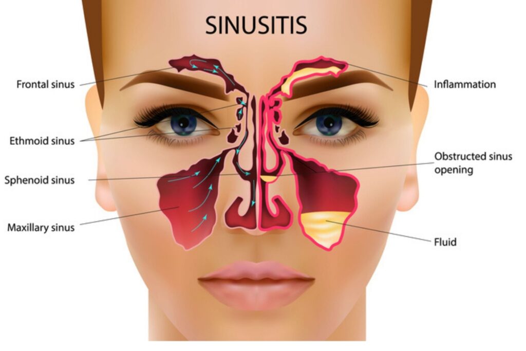 sinus infection, sinusitis 