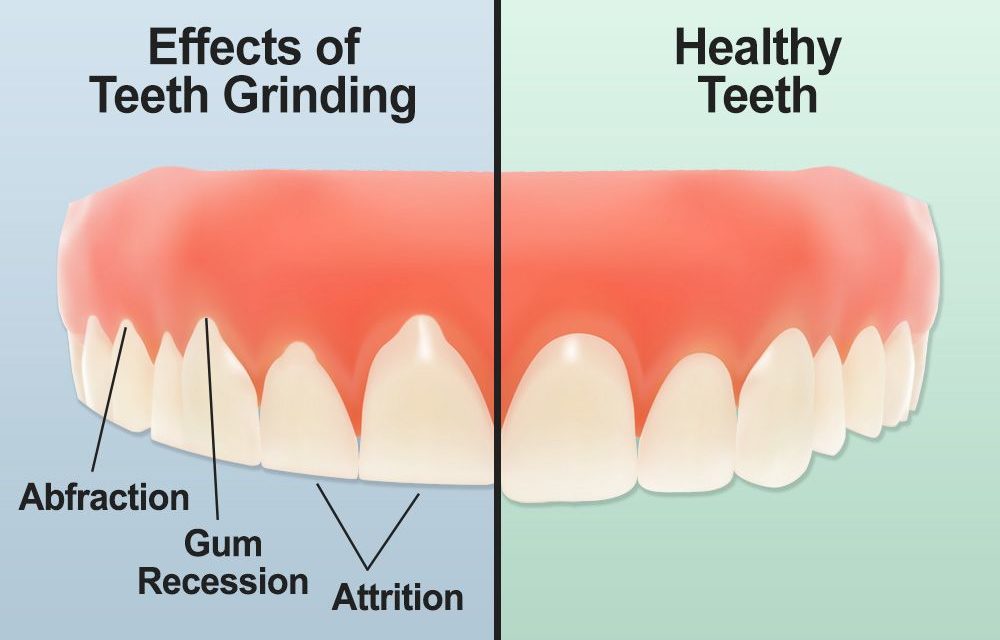 Diagram of teeth grinding