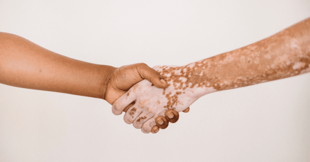 Person with vitiligo shaking hands with someone else