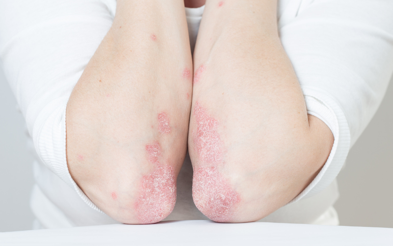 Person with psoriatic arthritis on their elbows