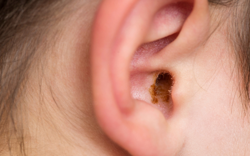 An ear with earwax buildup