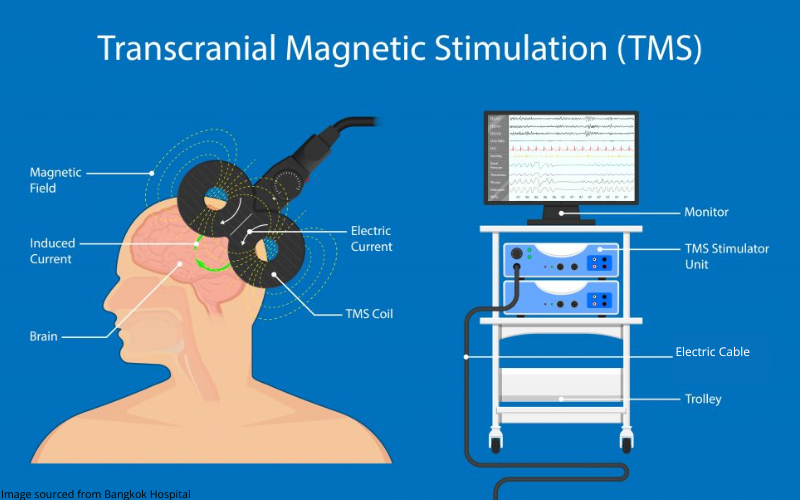 Diagram showing the process of TMS